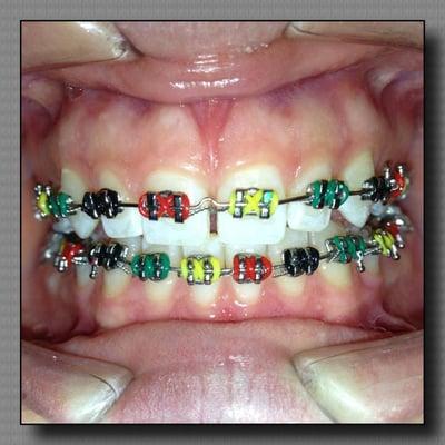 Our Patient had chosen this Rasta color to match her bracelet. Orthodontist here in San Leandro