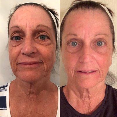 Facial after just 4 sessions