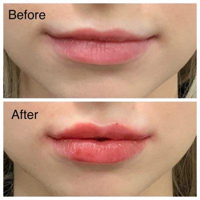 Restylane Lips!