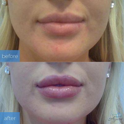 Lip Filler at Azura Skin Care Center