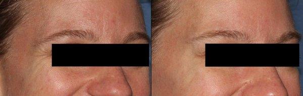 Botox - crow's feet - before/after