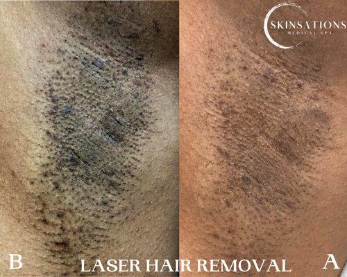 Laser Hair Removal gives awesome results! Our client experienced hyperpigmentation and ingrowns on her underarms which were eliminated!