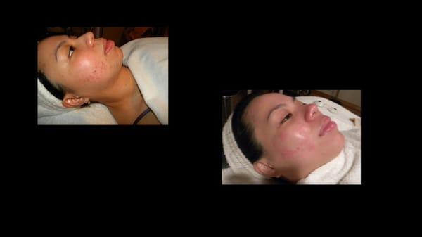 glo facial spa & skin center - acne specialist