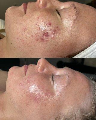 Chemical peel series + LED Therapy Transformation.