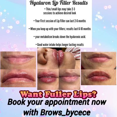 Lip fillers