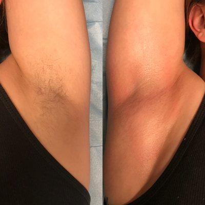 Armpit before and after because tank top season is coming for us!