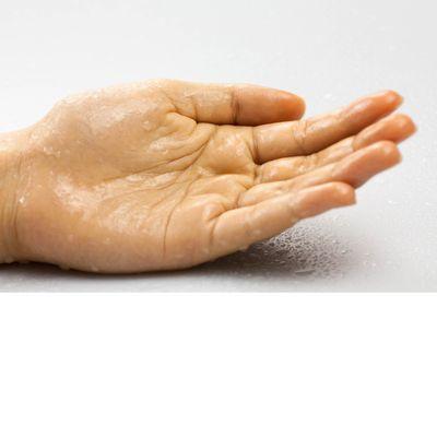 ETS - Surgery for Excessively Sweaty Hands