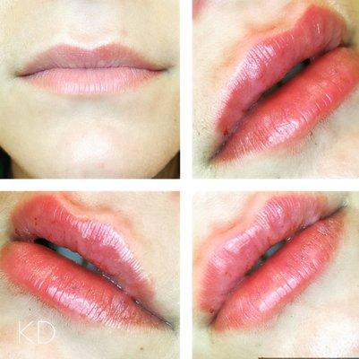 needle free lip augmentation