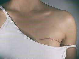 Mastectomy Massage
 Advanced Training