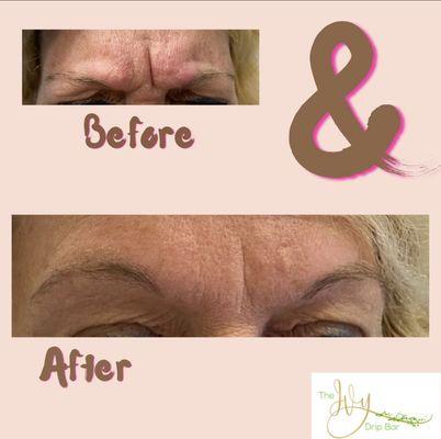 Before and after Botox, really helps to soften the frown line and helps to reduce the use of this over active muscle.