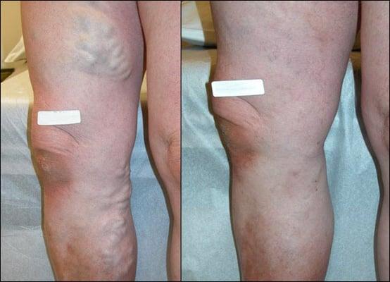 Varicose Vein Treatment and Therapy