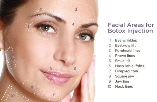 Botox injections sites