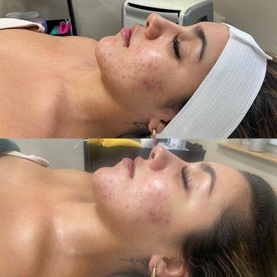 Before and after of the Glowing Beach Facial