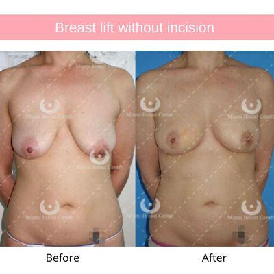 Before and after breast lift without incision.