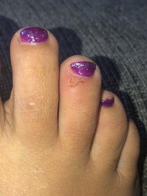 Burnt toe from callus treatment meant for bottom of feet, she put too much on and it dripped where it doesn't belong.