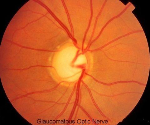 Optic nerve of a glaucoma patient diagnosed and treated at Master Eye Associates.