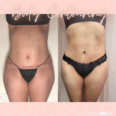 Body Contouring (6 Sessions)