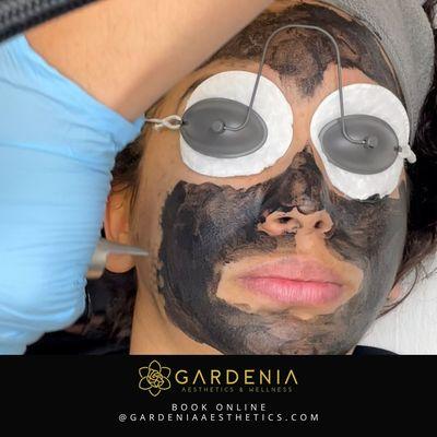 Carbon laser peel treatment. Great for oily skin, reduces pore size and helps resurface the skin.