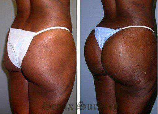 Before and after Brazilian Butt Lift