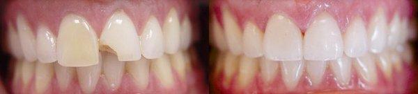 Veneers Before and After