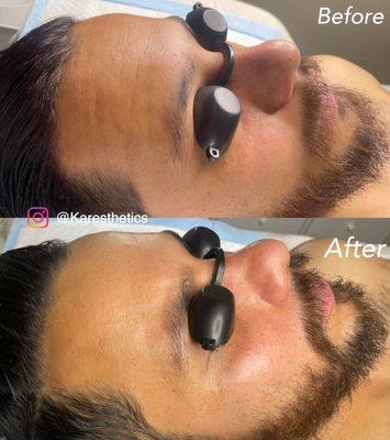 Mens Facial & Deep Detox Facial