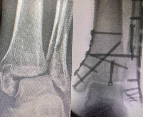 Ankle fracture