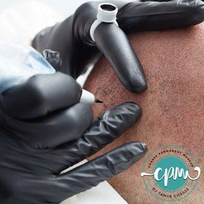 Scalp Micropigmentation