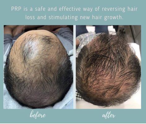 Platelet-rich plasma Hair Restoration