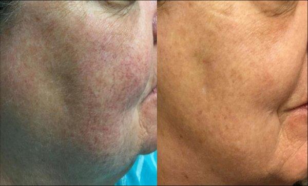 PhotoFacial is the best way to help with redness and veins.  No downtime