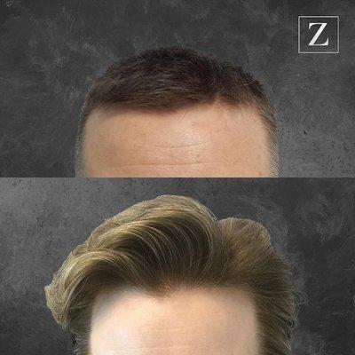 Male Hair Rejuvenation - FUE FUT