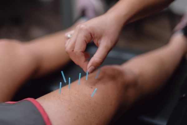 Dry Needling