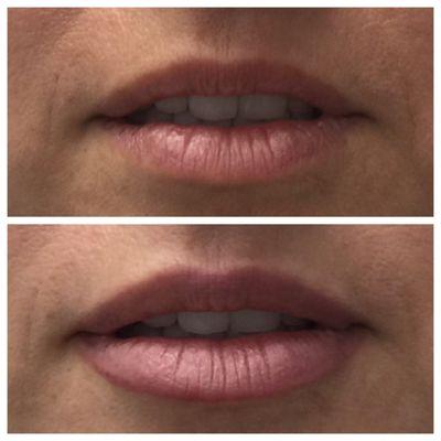 Lip rejuvenation