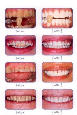 Whitening