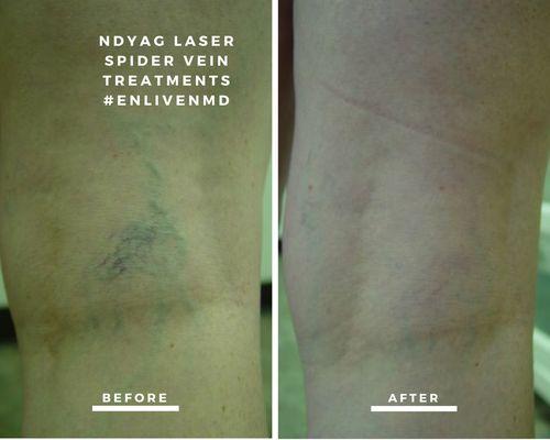 Spider vein treatments with Fotona NdYAG laser means no needles and no post-op hyperpigmentation #enlivenmd #theskincritics