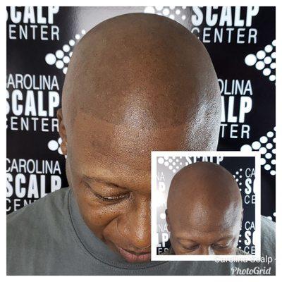 Scalp Micropigmentation was the best decision for this alopecia client.