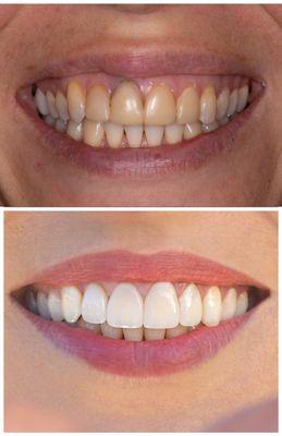 Smile design and incredible results achieved with four high quality nature like porcelain crowns!