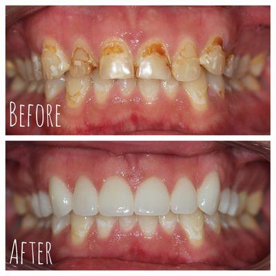 Smile transformation with 10 upper crowns