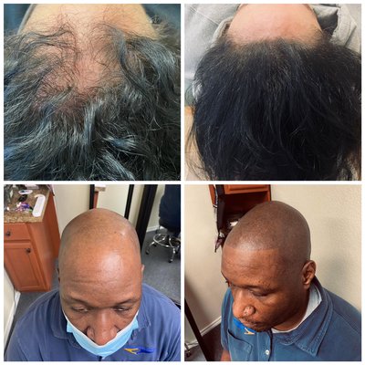 Scalp micro pigmentation for men and women