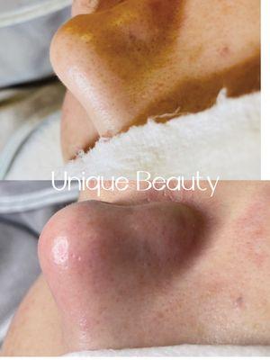 Deep pore cleaning