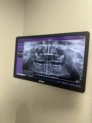 A panoramic scan of my mouth! technically advanced, and they even now offer CBCT scans (which looked so cool)