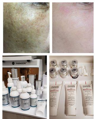 CHEMICAL PEEL abd SKIN REGENERATION for Uneven skin tone or MELASMA!