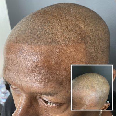 Scalp Micropigmentation - Hard Hairline