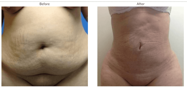 VASER Liposuction results, with no need at all for a Tummi Tuck procedure. This was achieved in just one session with Dr. Moreano.