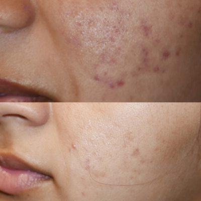 Micro-needling to help reduce the appearance of acne scars.