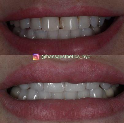 Hans Aesthetics Dental lab Aesthetics Porcelain veneers, cosmetic dentistry Aesthetic dental lab nyc dental lab feldspathic veneers