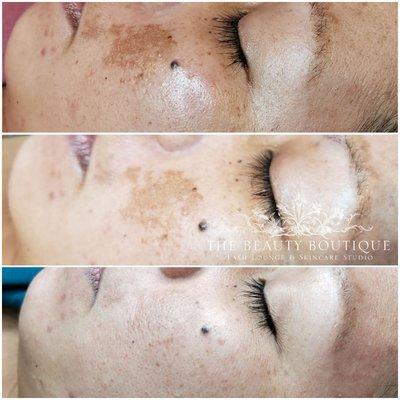 Melasma 3 months before and after.