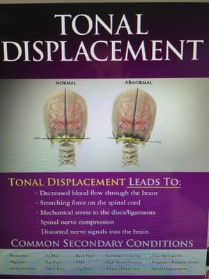 Example of how a displacement/shift in the neck increases tension on the spinal cord/nerves, causing symptoms.