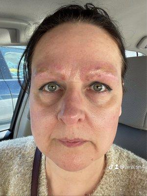 Botched eyebrow tattoo created by Barbara Alexis Ink. in Garden City, NY had to be laser removed by the doctor. Laser is painful