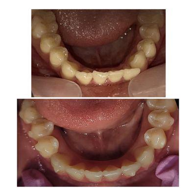 Invisalign Case