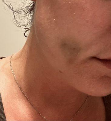 Right cheek bruise after dental procedure